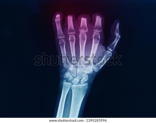 Anteroposterior Radiograph Xray Hand Showing Multiple Stock Photo ...