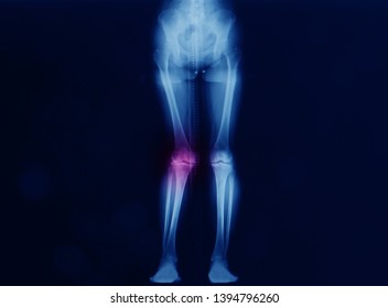 An anteroposterior radiograph or x-ray of lower extremities showing hip knee and ankle joint. The right knee shows severe valgus malalignment or knock knee and osteoarthritis. tka - Shutterstock ID 1394796260