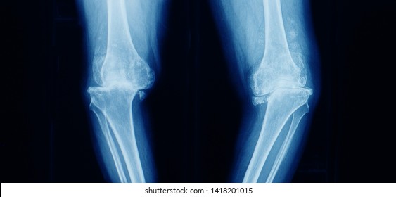 14,065 Bowed legs Images, Stock Photos & Vectors | Shutterstock