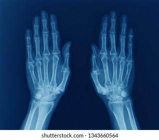 an anteroposterior x-ray or radiograph of both hands showing normal bones and joints. no sign of inflammation, arthritis, fracture, dislocation or de Quervain. - Shutterstock ID 1343660564