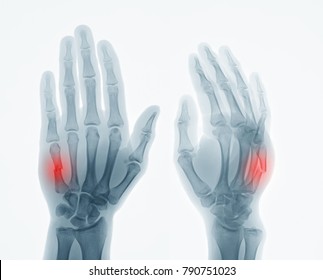 Anteroposteriorap Oblique Views Hand Xray Show Stock Photo (Edit Now ...