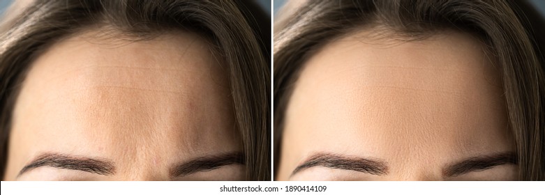 Anti Age Rejuvenation Forehead Lift Before And After : похожие изображения,...