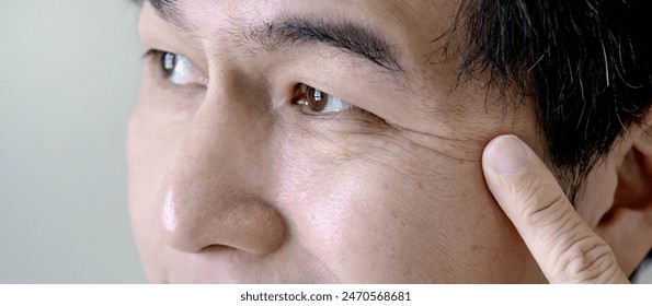 Anti aging concept. Closeup of crows feet on Asian man face, pointing at wrinkles at eye sides. Facial complexion treatment and rejuvenation by skincare and cosmetic cream. Mens beauty cosmetology. - Powered by Shutterstock