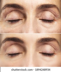 Anti Aging Treatment.  Comparison Of Female Eyes Before And After Rejuvenation.