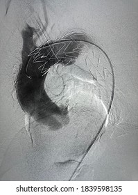 Aorta Angiogram Showed That Stent Graft Were Deployed To Aortic Arch To Descending Aorta During Thoracic Endovascular Aortic Repair (TEVAR).