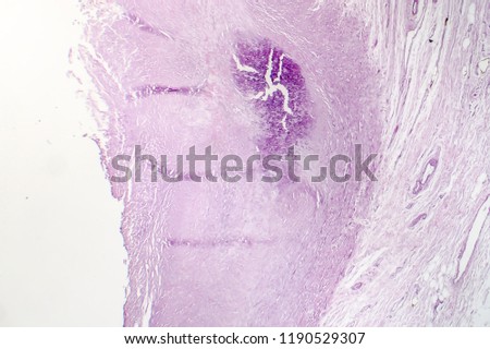 Aortic atherosclerosis, light micrograph, photo under microscope