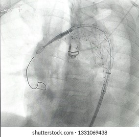 Aortic Stent Graft Was Placement And Deployment At Aortic Arch To Descending Aorta In TEVAR Procedure.