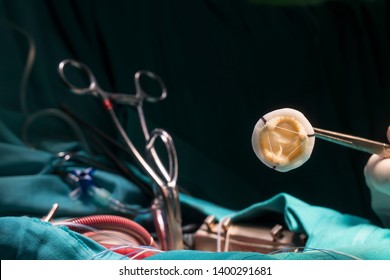 Aortic Valve Prosthesis. Image Of Heart Valve Implant During Open Heart Surgery.