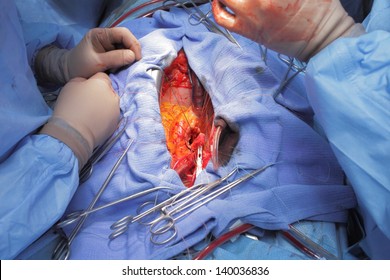 Aortic Valve Replacement. Open Heart.