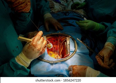 Aortic Valve Replacement Surgery On Of Human Heart Final Surgical Stitches Attaching Prosthesis To Aorta Wall