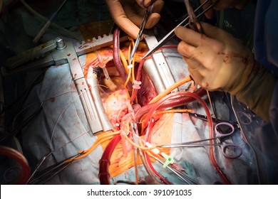 Aortic Valve Surgery, Median Sternotomy And Cardiopulmonary Bypass