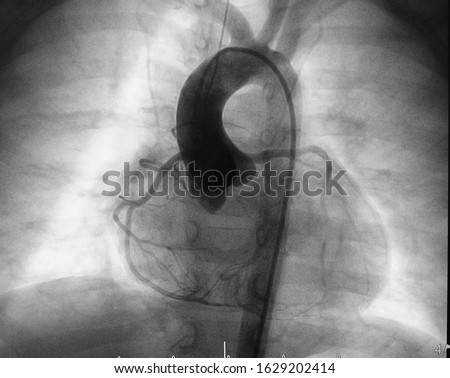 Aortogram of children with tetralogy of fallot disease (TOF) was performed normal aortic root, ascending aorta, left and right coronary artery and aortic arch