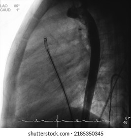 Aortogram Was Performed Descending Aorta After Patent Ductus Arteriosus (PDA) Closure Procedure.