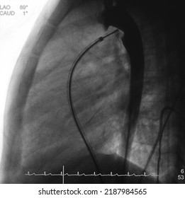 Aortogram Was Performed Descending Aorta During Deployed Device For Patent Ductus Arteriosus (PDA) Closure Procedure.