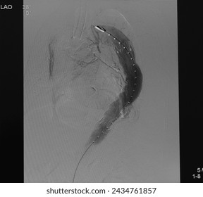 Aortogram was performed successful thoracic endovascular aortic repair (TEVAR) at descending aorta with aortic stent graft.