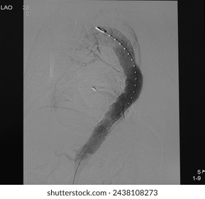 Aortogram was performed successful thoracic endovascular aneurysm repair (TEVAR) at descending aorta with aortic stent graft.