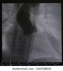 Aortogram Showed Aortic Root And Ascending Aorta