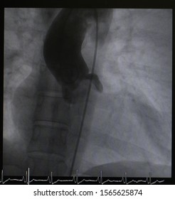 Aortogram Showed Ascending Aorta And Aortic Root While Aortic Valve Open