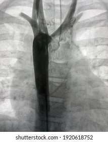 Aortogram Shown Aortic Arch And Descending Aorta In Congenital Heart Disease Patient.