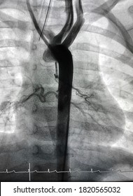 Aortogram Shown Major Aortopulmonary Collateral Arteries (MAPCAs) That Develop To Supply Blood To The Lungs In Tetralogy Of Fallot (TOF) Patients.