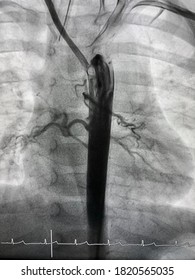 Aortogram Shown Major Aortopulmonary Collateral Arteries (MAPCAs) That Develop To Supply Blood To The Lungs In Tetralogy Of Fallot (TOF) Patients.