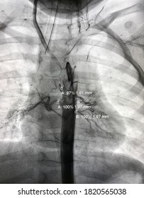 Aortogram Shown Major Aortopulmonary Collateral Arteries (MAPCAs) That Develop To Supply Blood To The Lungs In Tetralogy Of Fallot (TOF) Patients.