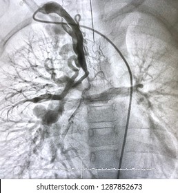 Aortography Showed Major Aortopulmonary Collateral Arteries (MAPCAs) In Pediatric, Which Is Congenital Heart Disease, At Cardiac Catheterization Room.