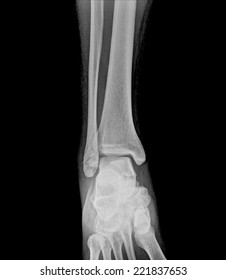 Normal Radiography Ankle Joint Lateral Projection Stock Photo (Edit Now ...