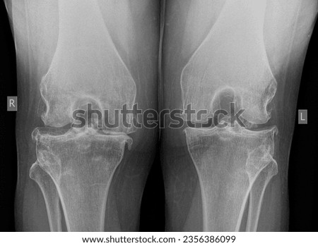 AP Xray knees with severe osteoarthritis