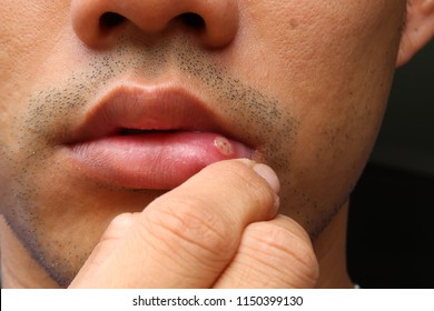 Aphthous Stomatitis ,lip Leison.