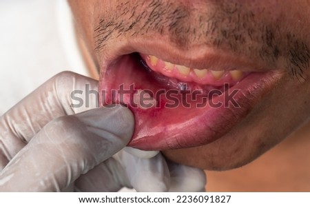 Aphthous ulcer, canker sore or stress ulcer in the mouth of Asian male patient.