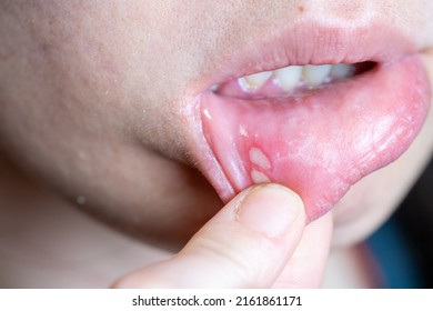 Aphthous Ulcer On The Lower Lip.