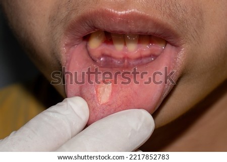 Aphthous ulcer or stress ulcer in mouth of Asian male patient.