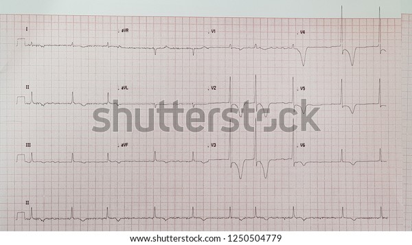 Apical Hypertrophic Cardiomyopathy Hcm Af Pseudoinfarction Stock Photo ...