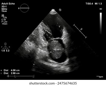 Apical Two chamber view on Transthoracic Echocardiography show left atrial myxoma size 4.06*2.96 mm
