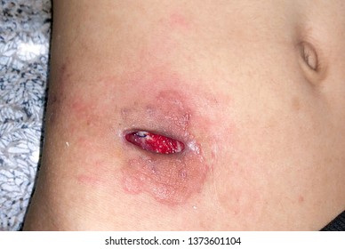 Appendectomy wound gaping or poor wound healing with granulation tissues, surrounding tinea fungal infection and cellulitis right lower abdomen due to bacterial infection in Asian adult male patient