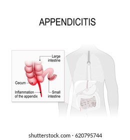Appendicitis, an inflammation of the appendix. Location of the appendix in the digestive system. Large intestine and appendix highlighted on the silhouette of a human. medical poster