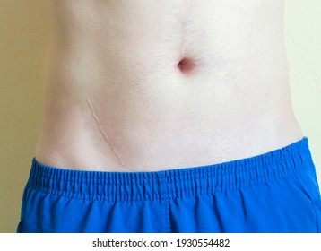 Appendicitis scar on a man's abdomen.