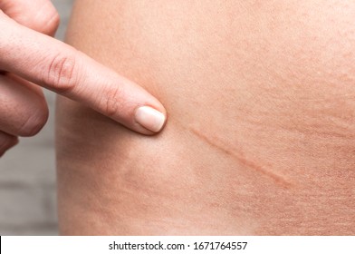 Appendicitis scar on woman's stomach