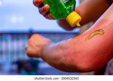 Applying Aloe Vera Gel To A Red Sunburn On An Arm