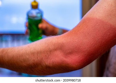 Applying Aloe Vera Gel To A Red Sunburn On An Arm