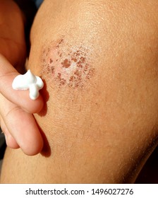 Applying Base Cream On A Healing Wound Or Scab In The Knee. Dermatological Condition Or Small Skin Injury Treatment. 