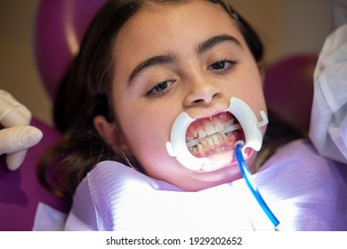 Applying braces for teeth to a cute little girl in dentist studio, patient wearing a mouth  opening tool.