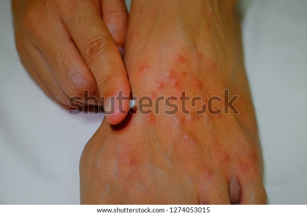 Applying cream on an itchy foot with red blisters\
resulting from fire\
ants