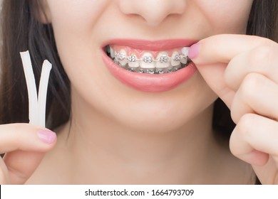 Applying orthodoentic wax on the dental braces. Brackets on the teeth after whitening. Self-ligating brackets with metal ties and gray elastics or rubber bands for perfect smile.