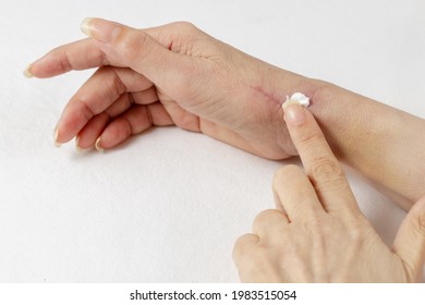 Applying a special medical cream or salve  to a healing scar after tendon surgery on a woman's hand. Scar care for elasticity. - Shutterstock ID 1983515054