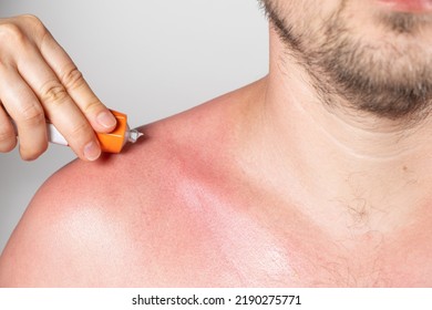 Applying Therapeutic Ointment To The Skin Of A Person With A Sunburn, Close-up.