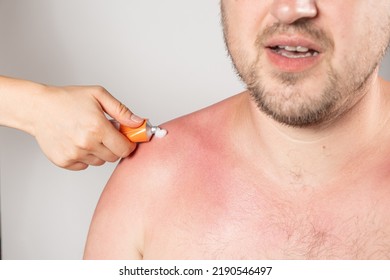 Applying Therapeutic Ointment To The Skin Of A Person With A Sunburn, Close-up