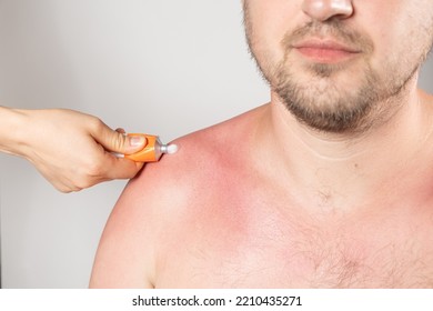 Applying Therapeutic Ointment To The Skin Of A Person With A Sunburn, Close-up.