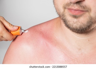 Applying Therapeutic Ointment To The Skin Of A Person With A Sunburn, Close-up